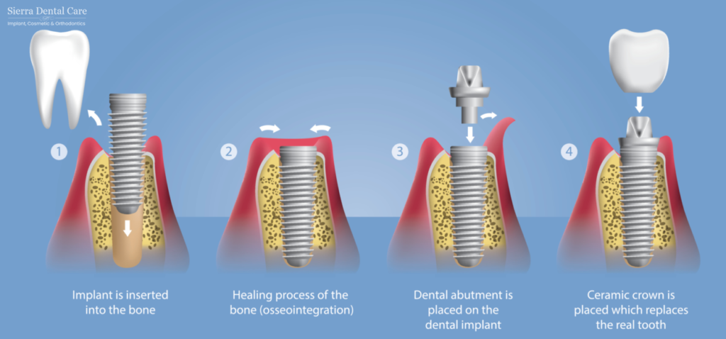 Dental Implants Santa Clarita CA