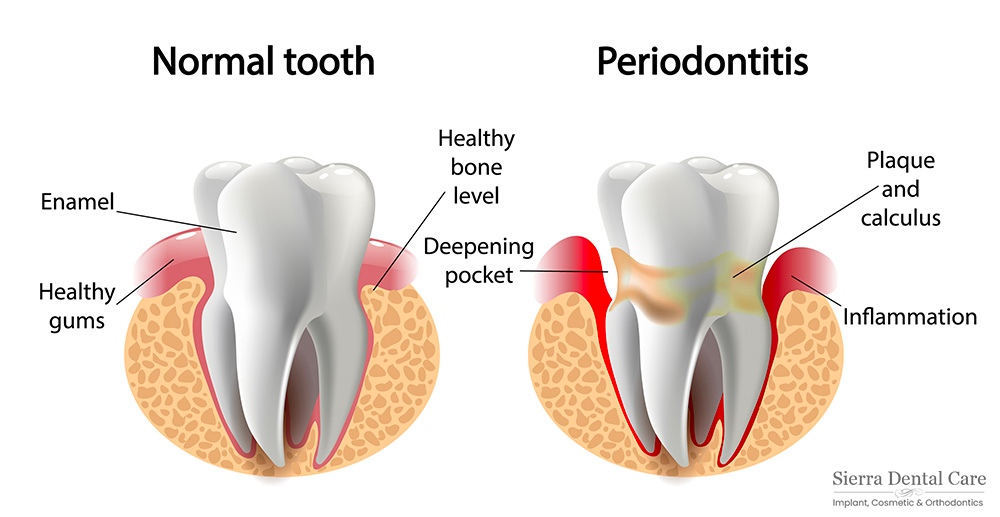 Periodontal Disease | Dentist Near Santa Clarita CA