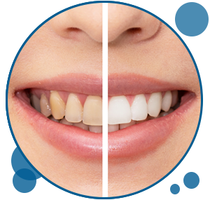 Teeth whitening | Cosmetic Dentistry Santa Clarita CA