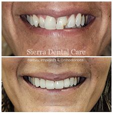 Oral Surgery Santa Clarita CA | Sierra Dental