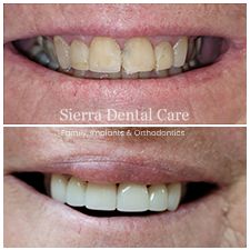 Periodontal disease | Dentist Near Santa Clarita CA
