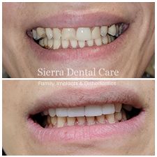 Periodontal disease | Dentist in Santa Clarita CA