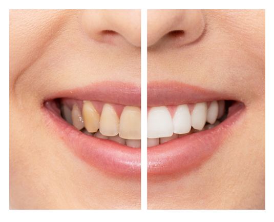 Cosmetic Dentistry Santa Clarita CA | Teeth Whitening